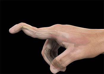 Mallet Finger Treatment Stoke-on-Trent | Mallet Finger Surgery Crewe