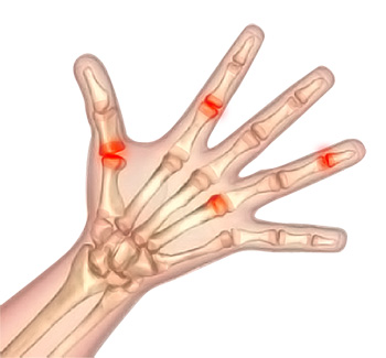 Arthritis of Hand