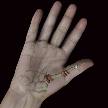 Arthritis Surgery for Thumb