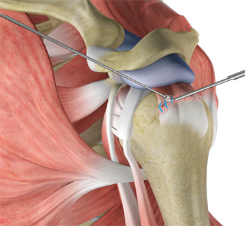 Arthroscopic Rotator Cuff Repair South Cheshire