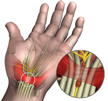 Carpal Tunnel Syndrome Staffordshire, Stoke-on-Trent | Carpal Tunnel  Release Cheshire