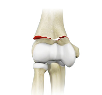 Distal Humerus Fractures of the Elbow