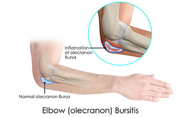 Elbow (Olecranon) Bursitis