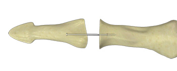 Fingerjoint Fusion