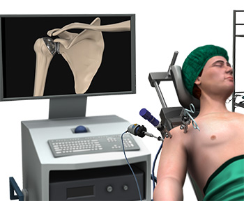 Minimally Invasive Shoulder Joint Replacement