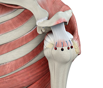 Rotator Cuff Repair