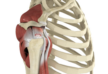 Rotator Cuff Tear