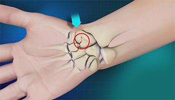 Scaphoid Fracture Stafford, UK | Scaphoid Bone Fracture Newcastle-under