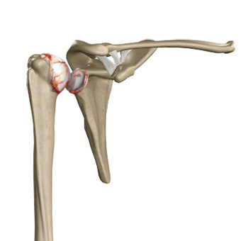 Arthritis of the Shoulder