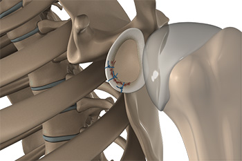 Shoulder Joint Tear