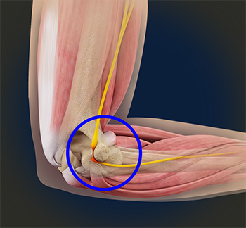 Cubital Tunnel Syndrome Ulnar Nerve Entrapment - Everything You